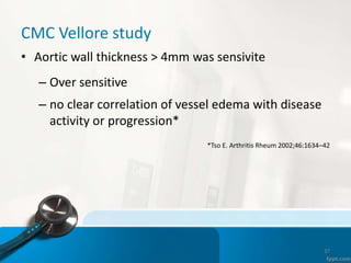 CMC Vellore study
• Aortic wall thickness > 4mm was sensivite
– Over sensitive
– no clear correlation of vessel edema with disease
activity or progression*
*Tso E. Arthritis Rheum 2002;46:1634–42
37
 