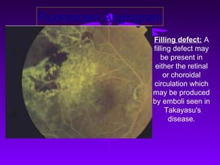 Fluorescein Angiogram
                   Filling defect: A
                   filling defect may
                       be present in
                    either the retinal
                        or choroidal
                   circulation which
                   may be produced
                   by emboli seen in
                        Takayasu's
                          disease.
 