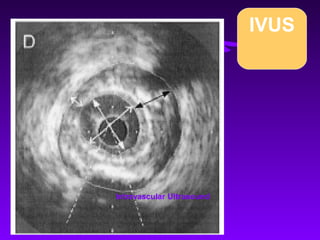 IVUS




Intravascular Ultrasound
 