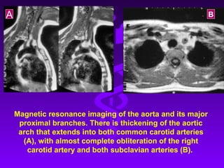 A                                                           B




    Magnetic resonance imaging of the aorta and its major
     proximal branches. There is thickening of the aortic
     arch that extends into both common carotid arteries
      (A), with almost complete obliteration of the right
       carotid artery and both subclavian arteries (B).
 