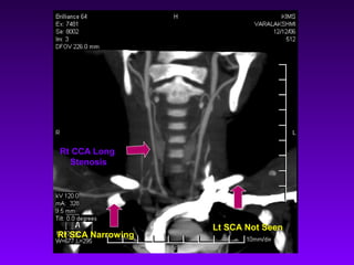 Rt CCA Long
  Stenosis




                   Lt SCA Not Seen
Rt SCA Narrowing
 
