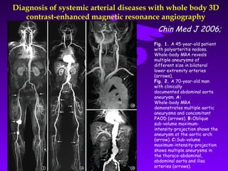 Diagnosis of systemic arterial diseases with whole body 3D
   contrast-enhanced magnetic resonance angiography
                                        Chin Med J 2006;
                                       Fig. 1. A 45-year-old patient
                                       with polyarteritis nodosa.
                                       Whole-body MRA reveals
                                       multiple aneurysms of
                                       different size in bilateral
                                       lower extremity arteries
                                       (arrows).
                                       Fig. 2. A 70-year-old man
                                       with clinically
                                       documented abdominal aorta
                                       aneurysm. A:
                                       Whole-body MRA
                                       demonstrates multiple aortic
                                       aneurysms and concomitant
                                       PAOD (arrows). B:Oblique
                                       sub-volume maximum-
                                       intensity-projection shows the
                                       aneurysm at the aortic arch
                                       (arrow). C:Sub-volume
                                       maximum-intensity-projection
                                       shows multiple aneurysms in
                                       the thoraco-abdominal,
                                       abdominal aorta and iliac
                                       arteries (arrows).
 