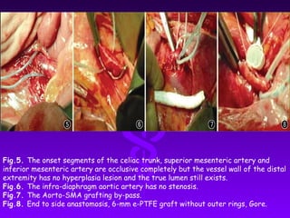 Fig.5. The onset segments of the celiac trunk, superior mesenteric artery and
inferior mesenteric artery are occlusive completely but the vessel wall of the distal
extremity has no hyperplasia lesion and the true lumen still exists.
Fig.6. The infra-diaphragm aortic artery has no stenosis.
Fig.7. The Aorto-SMA grafting by-pass.
Fig.8. End to side anastomosis, 6-mm e-PTFE graft without outer rings, Gore.
 