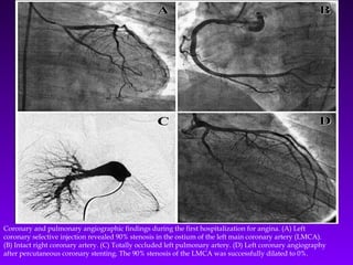Coronary and pulmonary angiographic findings during the first hospitalization for angina. (A) Left
coronary selective injection revealed 90% stenosis in the ostium of the left main coronary artery (LMCA).
(B) Intact right coronary artery. (C) Totally occluded left pulmonary artery. (D) Left coronary angiography
after percutaneous coronary stenting. The 90% stenosis of the LMCA was successfully dilated to 0%.
 