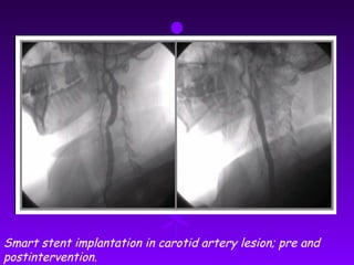 Smart stent implantation in carotid artery lesion; pre and
postintervention.
 