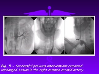 Fig. 5 - Successful previous interventions remained
unchanged. Lesion in the right common carotid artery.
 