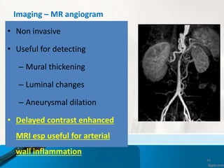 Imaging – MR angiogram
• Non invasive
• Useful for detecting
– Mural thickening
– Luminal changes
– Aneurysmal dilation
• ...