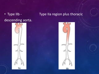• Type IIb - Type IIa region plus thoracic
descending aorta.
 