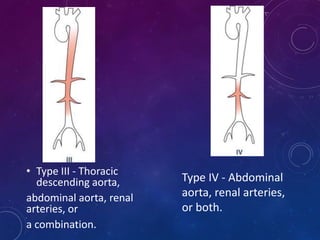 • Type III - Thoracic
descending aorta,
abdominal aorta, renal
arteries, or
a combination.
Type IV - Abdominal
aorta, renal arteries,
or both.
 