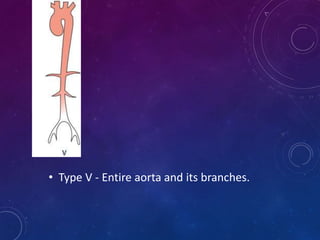 • Type V - Entire aorta and its branches.
 