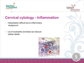 Cervical cytology - Inflammation
 Interpretation difficult due to inflammatory
background
 Lot of neutrophils and blood can obscure
cellular details
 