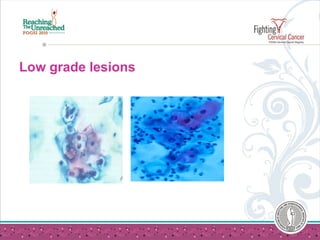 Low grade lesions
 