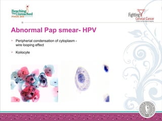 Abnormal Pap smear- HPV
 Peripherial condensation of cytoplasm -
wire looping effect
 Koilocyte
 