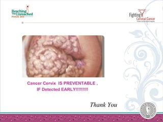 Cancer Cervix IS PREVENTABLE ,
IF Detected EARLY!!!!!!!!!
Thank You
 