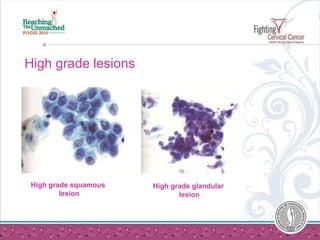High grade lesions High grade squamous  lesion High grade glandular  lesion 