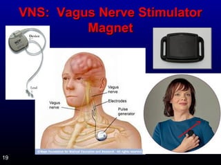 VNS: VVaagguuss NNeerrvvee SSttiimmuullaattoorr 
MMaaggnneett 
19 
 