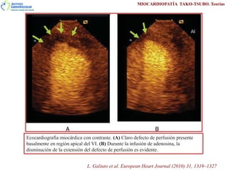 Ecocardiografía miocárdica con contraste. (A) Claro defecto de perfusión presente
basalmente en región apical del VI. (B) ...