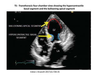 Broken Heart Syndrome: Stress-Induced Cardiomyopathy