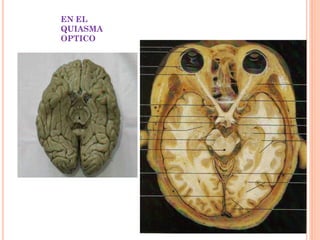 EN EL
QUIASMA
OPTICO

 