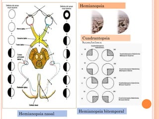Hemianopsia
Homónima

Cuadrantopsia
homónima

Hemianopsia nasal

Hemianopsia bitemporal

 
