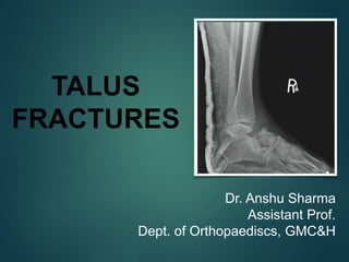 TALUS
FRACTURES
Dr. Anshu Sharma
Assistant Prof.
Dept. of Orthopaediscs, GMC&H
 