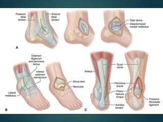 Talus Slides TALUS FRACTURE AND MANAGEMENT. | PPTX