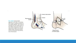 Talus Slides Talar Fractures (Fractures of Talus Bone).pptx