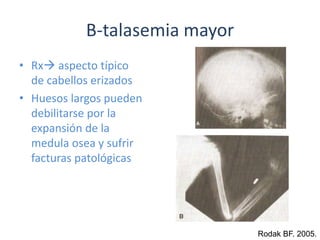B-talasemia mayorRx aspecto típico de cabellos erizados