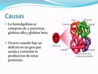 Causas
 La hemolgobina se
 compone de 2 proteinas,
 globina alfa y globina beta.

 Ocurre cuando hay un
 defecto en un gen que
 ayuda a controlar la
 produccion de estas
 proteinas.
 