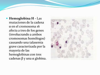  Hemoglobina H - Las
 mutaciones de la cadena
 α en el cromosoma 16
 afecta a tres de los genes
 (involucrando a ambos
 cromosomas homólogos)
 causando una talasemia
 grave caracterizada por la
 mayoría de las
 hemoglobinas con tres
 cadenas β y una α globina.
 