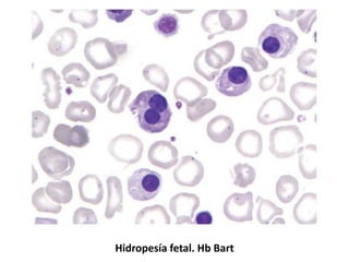Hidropesía fetal. Hb Bart
 