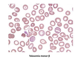 Talasemia menor β
 