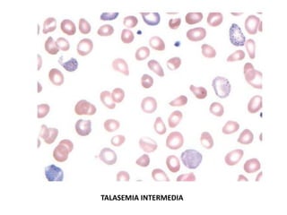 TALASEMIA INTERMEDIA
 