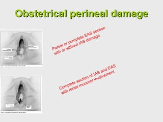 Complete section of IAS and EAS
with rectal mucosal involvement
Partial or complete EAS section
with or without IAS damage
Obstetrical perineal damageObstetrical perineal damage
 