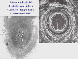 A: tessuto subepiteliale
B : sfintere anale interno
C: muscolo longitudinale
D : sfintere esterno
 