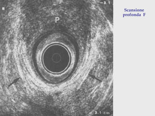 Pasquale Talento, www.coloprocto.itPasquale Talento, www.coloprocto.it
Scansione
profonda F
 
