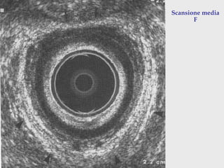 Pasquale Talento, www.coloprocto.itPasquale Talento, www.coloprocto.it
Scansione media
F
 