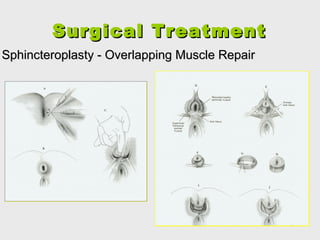 Surgical TreatmentSurgical Treatment
Sphincteroplasty - Overlapping Muscle RepairSphincteroplasty - Overlapping Muscle Repair
 