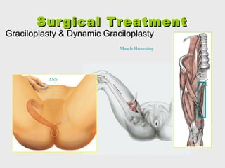 SurgicalSurgical TreatmentTreatment
Graciloplasty & Dynamic GraciloplastyGraciloplasty & Dynamic Graciloplasty
Muscle Harvesting
SNS
 