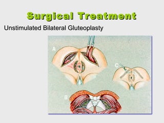 SurgicalSurgical TreatmentTreatment
Unstimulated Bilateral GluteoplastyUnstimulated Bilateral Gluteoplasty
.
 