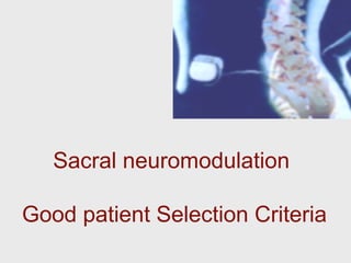Sacral neuromodulation
Good patient Selection Criteria
 