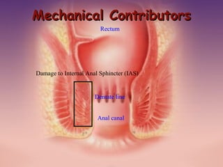 Pasquale Talento, www.coloprocto.it
Damage to Internal Anal Sphincter (IAS)
Rectum
Anal canal
Dentate line
Mechanical ContributorsMechanical Contributors
 