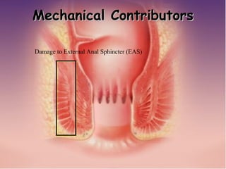 Pasquale Talento, www.coloprocto.it
Damage to External Anal Sphincter (EAS)
Mechanical ContributorsMechanical Contributors
 