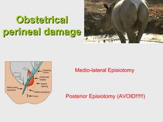 ObstetricalObstetrical
perineal damageperineal damage
Medio-lateral Episiotomy
Posterior Episiotomy (AVOID!!!!!)
 