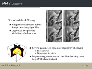 MM / Discussion
Smoothed shock filtering
Original contribution: robust
image denoising algorithm
Approved by applying
deﬁnition of robustness
Several parameters modulate algorithm’s behavior
Shock impact
Number of iterations
Improves segmentation and machine learning tasks
(e.g. fMRI classiﬁcation)
Antoine Vacavant 24 / 55
 