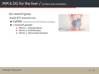 MM & DG for the liver / Context and motivation
Our research group
Inside IGT research axis
CaVITI (Cardio-Vascular Interventional Therapy and Imaging)
3 research groups
Theme 1: Endoprothesis
Theme 2: Embolization
Theme 3: Myocardial function
Antoine Vacavant 42 / 55
 