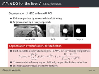 MM & DG for the liver / HCC segmentation
Segmentation of HCC within MRI ROI
Enhance patches by smoothed shock ﬁltering
Segmentation by a fuzzy approach
Input MRI ROI SSF Output
Segmentation by fuzzification/defuzzification
First calculate a fuzzy clustering by FCMVC (with variable compactness)
JFCMVC
n
j 1
c
i 1
ˆµij(xj − vi)2pi , ˆµij
(xj − vi)−2pi
c
i 1
(xj − vi)−2pi
Then calculate a binary segmentation by sequential feature selection
Including geometrical and fuzzy features
Antoine Vacavant 44 / 55
 