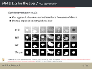 MM & DG for the liver / HCC segmentation
Some segmentation results
Our approach also compared with methods from state-of-the-art
Positive impact of smoothed shock ﬁlter
ROI
SSF
GT
Output
A. Vacavant, A.-R. Ali, M. Grand-Brochier, A. Albouy-Kissi, J.-Y. Boire, A. Alﬁdja et P. Chabrot: Smoothed shock ﬁltered defuzziﬁcation with Zernike
moments for liver tumor extraction in MR images. In IEEE IPTA 2015, Orléans, France, Nov. 2015.
Antoine Vacavant 45 / 55
 