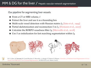 MM & DG for the liver / Hepatic vascular network segmentation
Our pipeline for segmenting liver vessels
From a CT or MRI volume, I
Extract the liver and use it as a bounding box
Multi-scale vessel detection with Hessian matrix IS [Sato et al., 1994]
Partial skeletonization and reconnection S in IS [Homann et al., 2007]
Calculate the RORPO vesselness ﬁlter IR [Merveille et al., 2018]
Use S as initialization for fast marching segmentation within IR
M.-A. Lebre, A. Vacavant, M. Grand-Brochier, O. Merveille, A. Abergel, P. Chabrot, B. Magnin: Automatic 3-D Skeleton-based Segmentation of Liver
Vessels From MRI and CT for Couinaud Representation. In IEEE ICIP 2018, Athens, Greece,
Antoine Vacavant 47 / 55
 