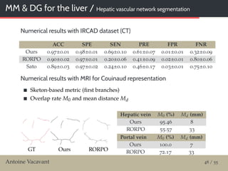 MM & DG for the liver / Hepatic vascular network segmentation
Numerical results with IRCAD dataset (CT)
ACC SPE SEN PRE FPR FNR
Ours 0.97±0.01 0.98±0.01 0.69±0.10 0.61±0.07 0.01±0.01 0.32±0.09
RORPO 0.90±0.02 0.97±0.01 0.20±0.06 0.41±0.09 0.02±0.01 0.80±0.06
Sato 0.89±0.03 0.97±0.02 0.24±0.10 0.46±0.17 0.03±0.01 0.75±0.10
Numerical results with MRI for Couinaud representation
Sketon-based metric (ﬁrst branches)
Overlap rate M0 and mean distance Md
Hepatic vein M0 (%) Md (mm)
Ours 95.46 8
RORPO 55.57 33
Portal vein M0 (%) Md (mm)
Ours 100.0 7
RORPO 72.17 33
Antoine Vacavant 48 / 55
 